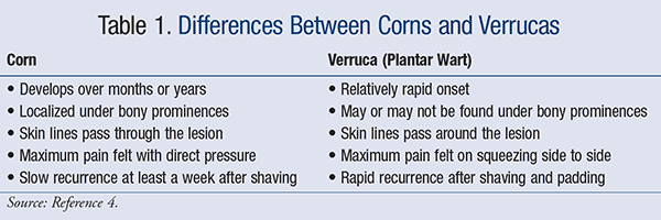 Symptoms and Treatment for Corns and Calluses