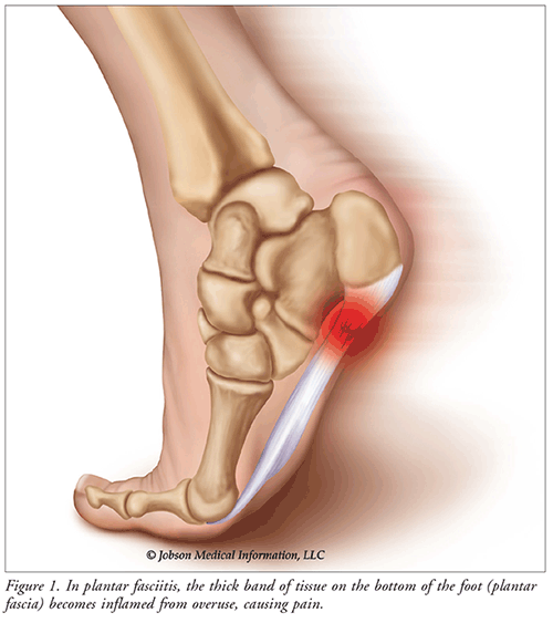tear in arch of foot