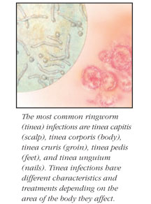 Ringworm Infections