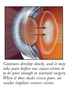 how quickly do cataracts develop