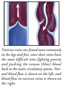 Varicose Veins