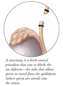 Vasectomy, Vasectomy Procedure