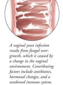 vaginal yeast infection discharge cottage cheese